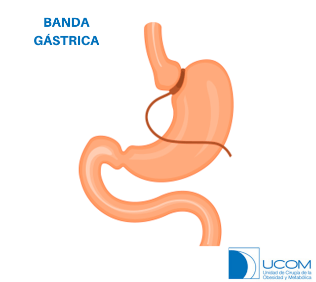 Banda gástrica aplicada en el intestino grueso