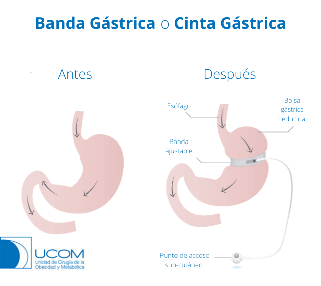 antes y despues de la operación de banda gastrica en Barcelona