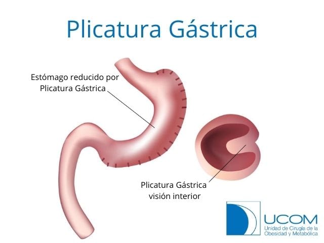 plicatura gástrica