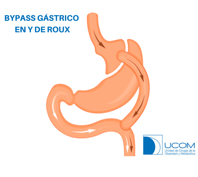 Bypass gástrico en Y de roux