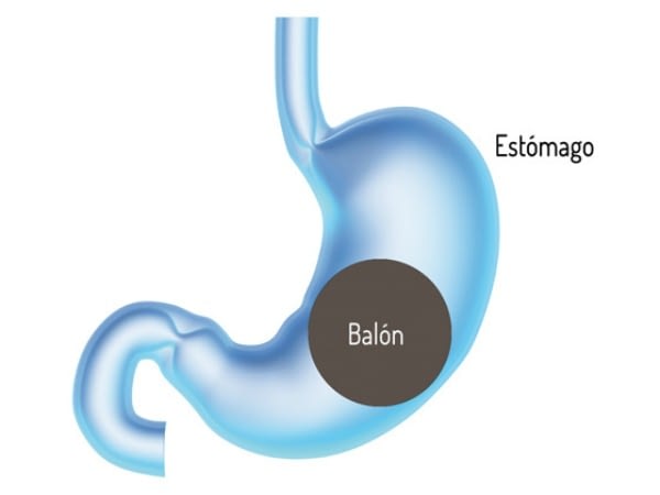 Balon gastrico
