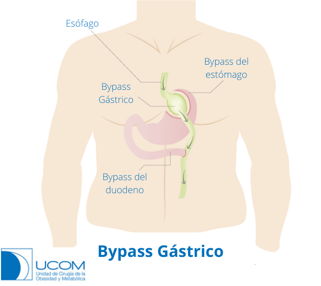 Bypass gástrico